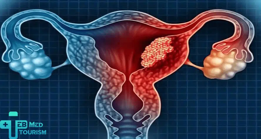 ماهو الإنتباذ البطاني الرحمي؟