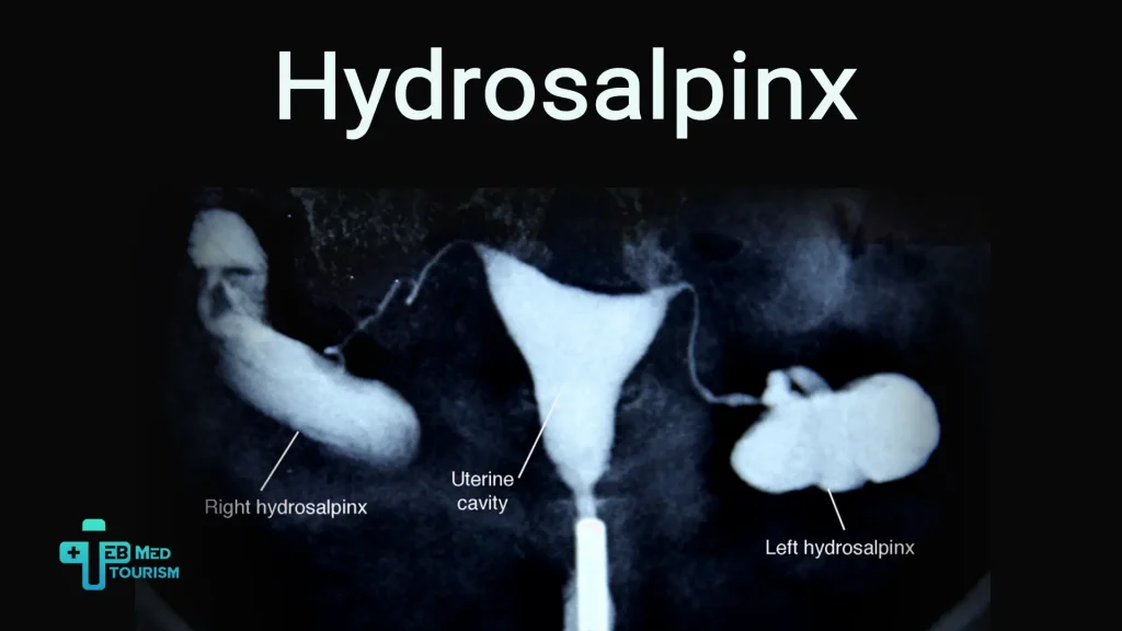 What is hydrosalpinx? What are the symptoms, causes, and treatment?
