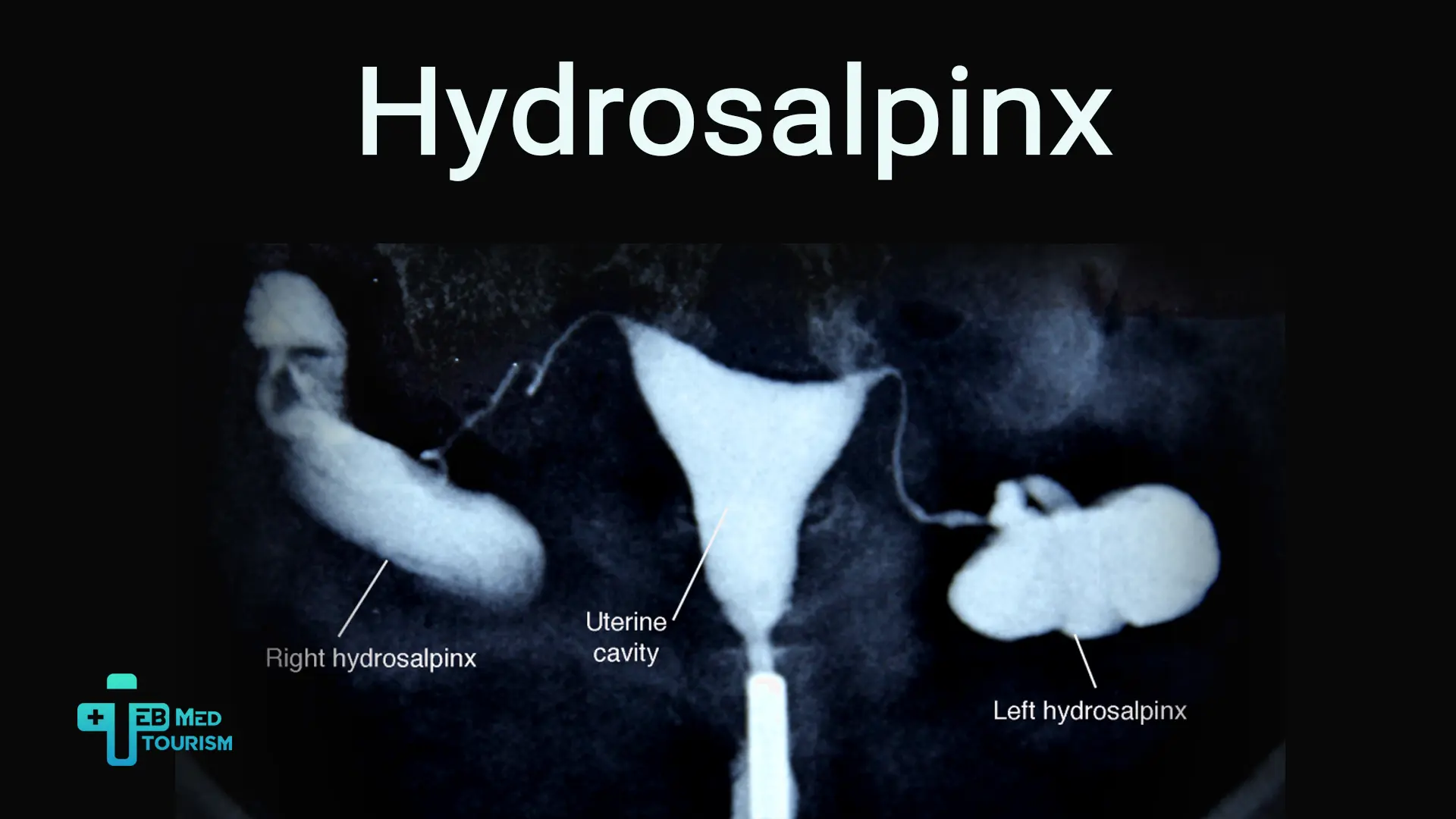 What is hydrosalpinx? What are the symptoms, causes, and treatment?
