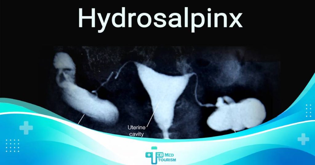 hydrosalpinx the symptoms, causes, and treatment