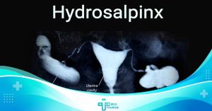 hydrosalpinx the symptoms, causes, and treatment