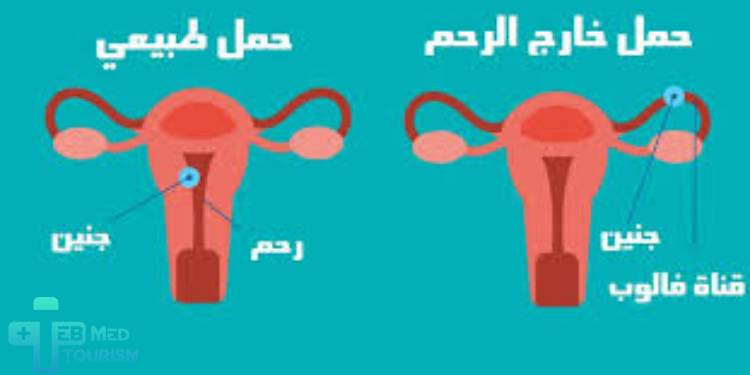 ما الفرق بين الحمل الطبيعي والحمل خارج الرحم؟