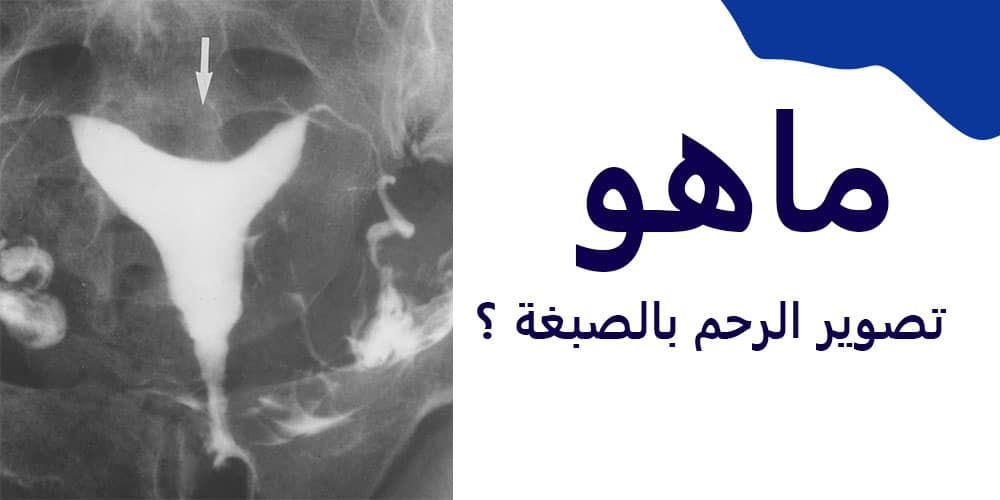 تصوير الرحم بالصبغة أو Hysterosalpingography) HSG) هو نوع من التصوير الذي يتم إجراؤه على الحوض والأعضاء التناسلية الأنثوية.