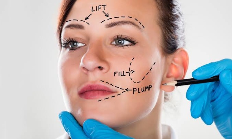 Facelift