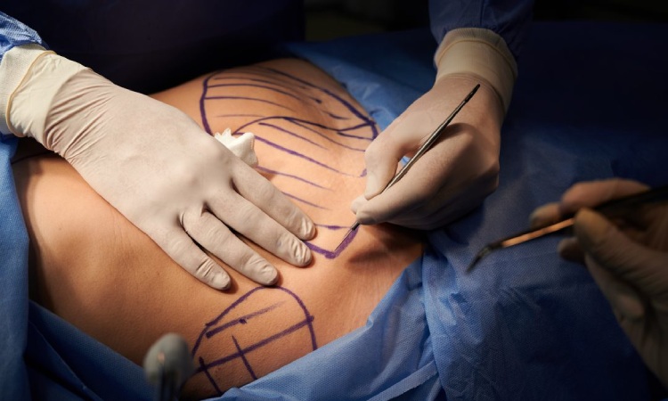 Abdominoplasty