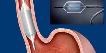 مقدمة حول علاج ارتجاع حمض المعدة (الارتجاع المعدي المريئي) عن طريق الاستئصال التنظيري بالترددات الراديوية RFA
