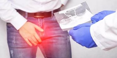 كل ما تحتاج لمعرفته حول دوالي الخصية (القيلة الدوالية) و استئصال دوالي الخصية