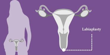 Labiaplasty