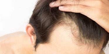 FUE-vs-FUT-blog-1024x620-1