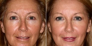 الميزوثيرابي للبشرة في إيران