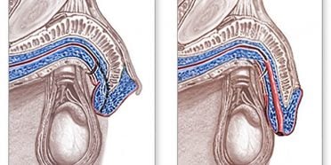 الإحليل التحتي ( المبال السفلي )