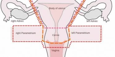 استئصال الرحم