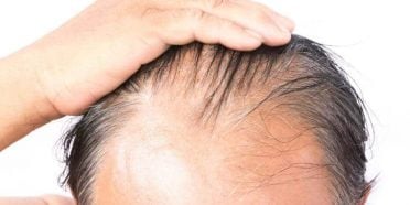 تساقط الشعر أو الصلع بعد زراعة الشعر