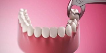 قلع الاسنان المتضررة في ايران