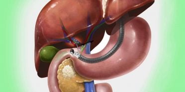 فوائد تصوير البنكرياس والأقنية الصفراوية بالتنظير الباطني بالطريق الراجع ERCP