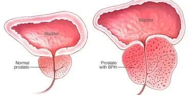 استئصال البروستاتا عبر الإحليل (TURP) في ايران