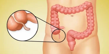 استئصال الزائدة الدودية