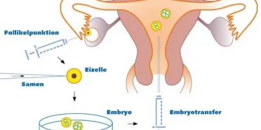 الحقن المجهري (حقن الحيوانات المنوية داخل الهيولى) و التشخيص الجيني قبل الزرع PGD
