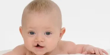 الشفة المشقوقة من جانب واحد