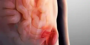 الفتق الإربي: الأنواع و الأعراض والعلاجات