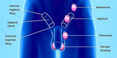 تثبيت الخصية أو إنزال الخصية (الخصية المعلّقة أو النطاطة)