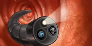 تنظير القولون في ايران