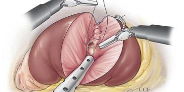 جراحة استئصال الكلية في ايران