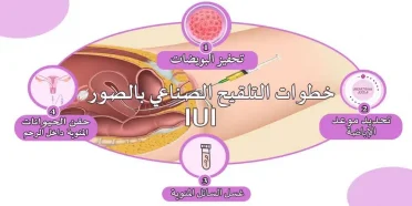 خطوات التلقيح الصناعي بالصور