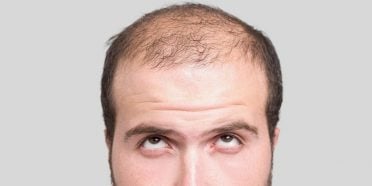 زراعة الشعر في ايران