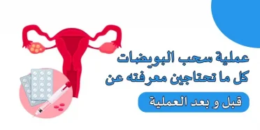 سحب البويضات