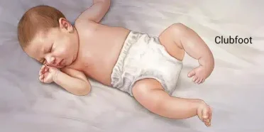 كل شيء عن حنف القدم وأنواعه وعلاجه