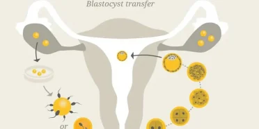 نقل الكيسة الأريمية و نقل الأجنة في إيران