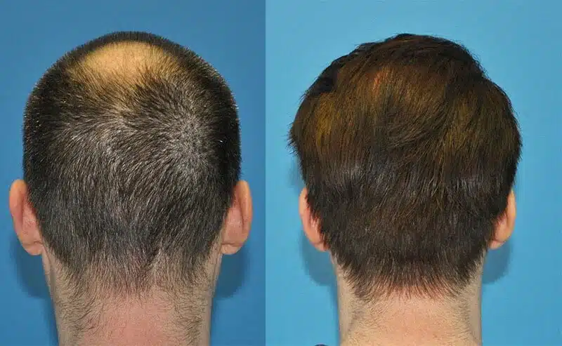 زراعة الشعر في الرجال