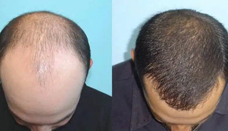 ما هي التقنيات المستخدمة في زراعة الشعر؟