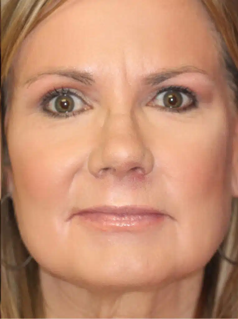 الصور أدناه تصور المريض أثناء وبعد تقشير حمض الساليسيليك