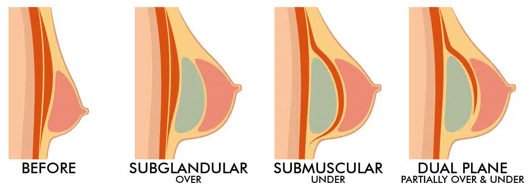 breast-enlargement-images-headers_surgery-1