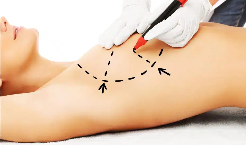 breast-reduction-surgery-mammoplasty-99