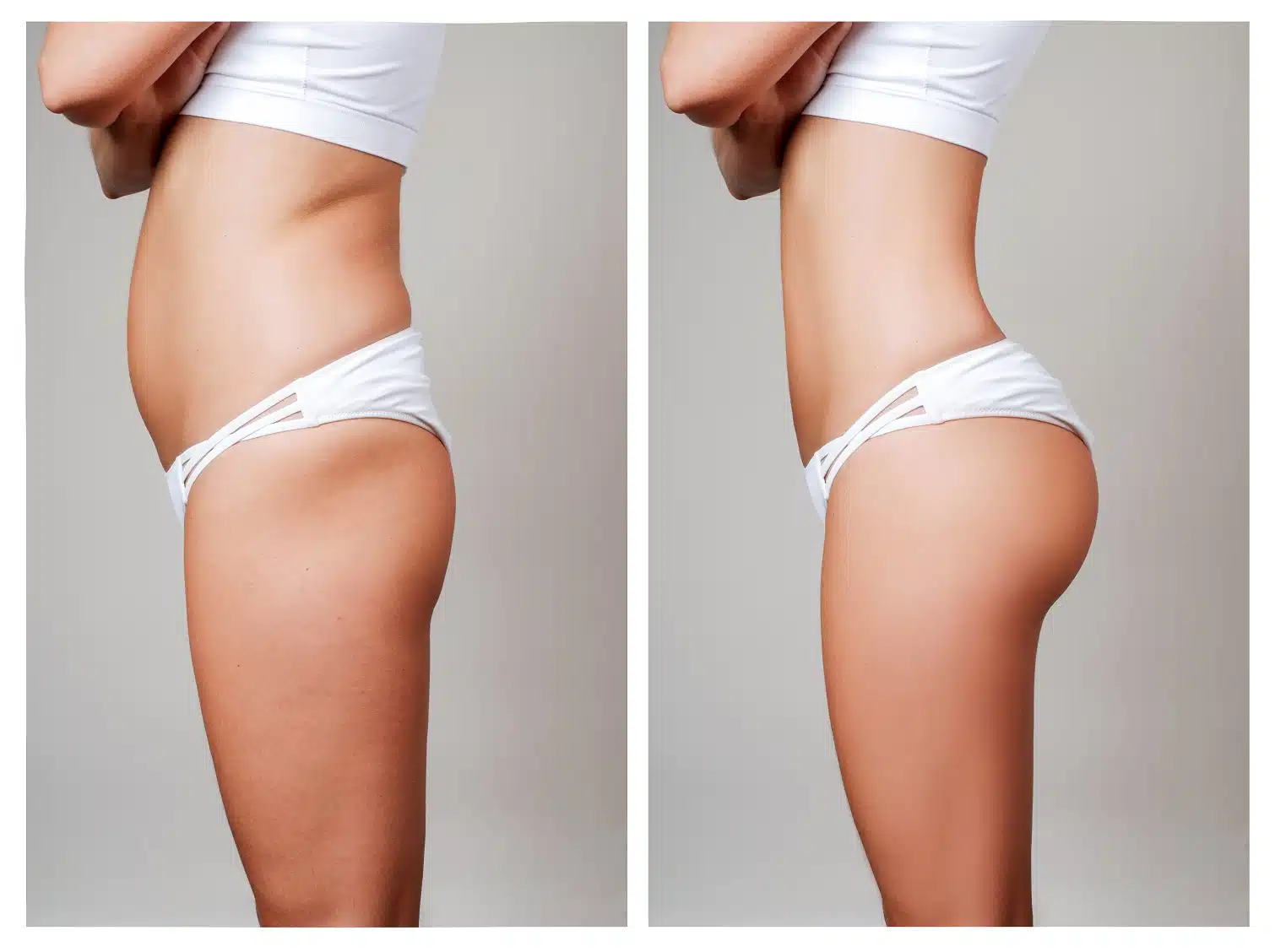 Butt Lift Gluteoplasty22