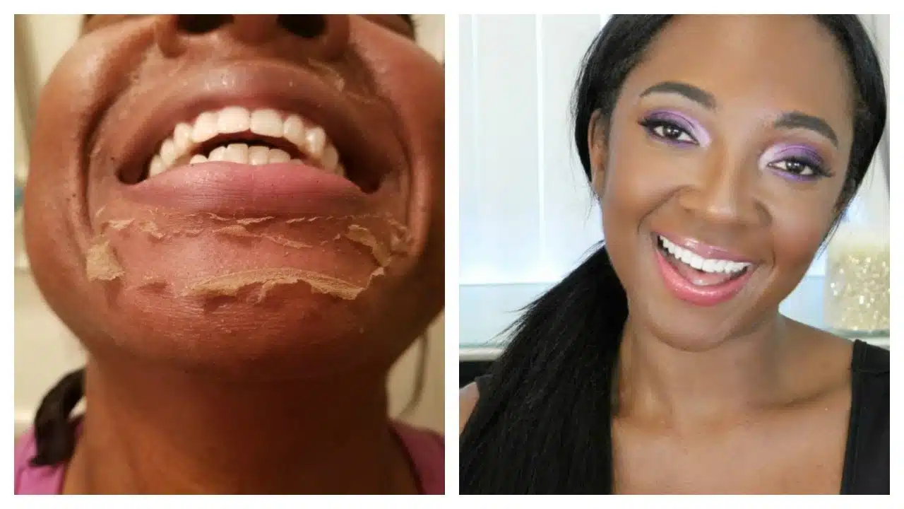 هل التقشير الکیمیائي مؤلم؟