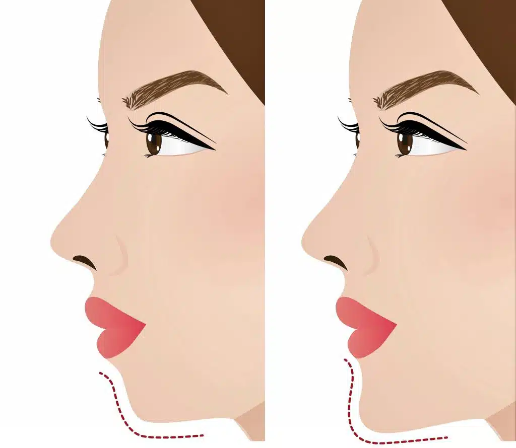 chin-augmentation-genioplasty-1024x890