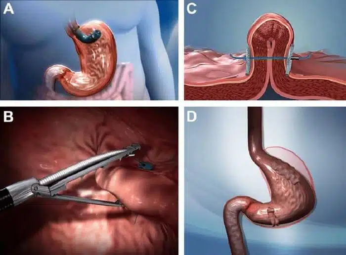endoscopic-gastric-plication-using-the-pose-tm-procedure-primary-obesity-surgery223