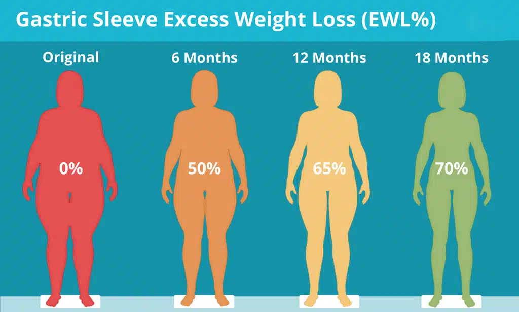 gastric-sleeve-excess-weight-loss-ewl-1