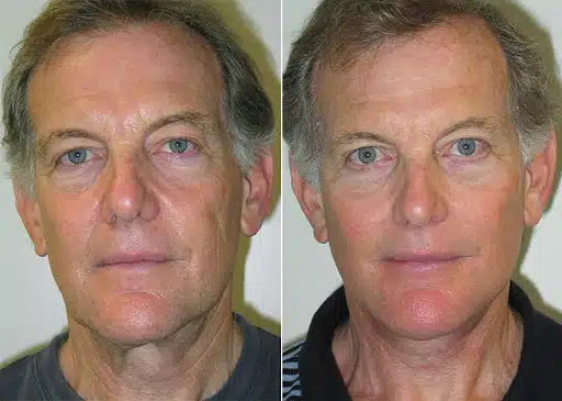 preparing-for-your-fat-transfer