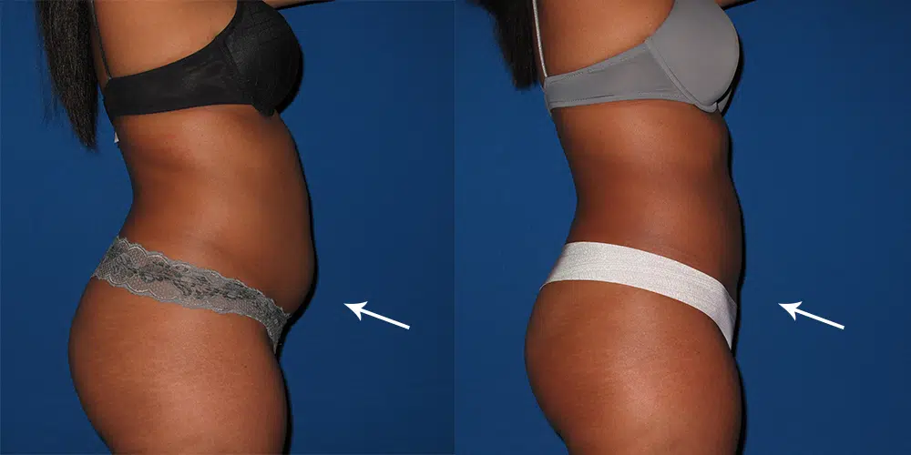 abdominal-liposuction-3-2