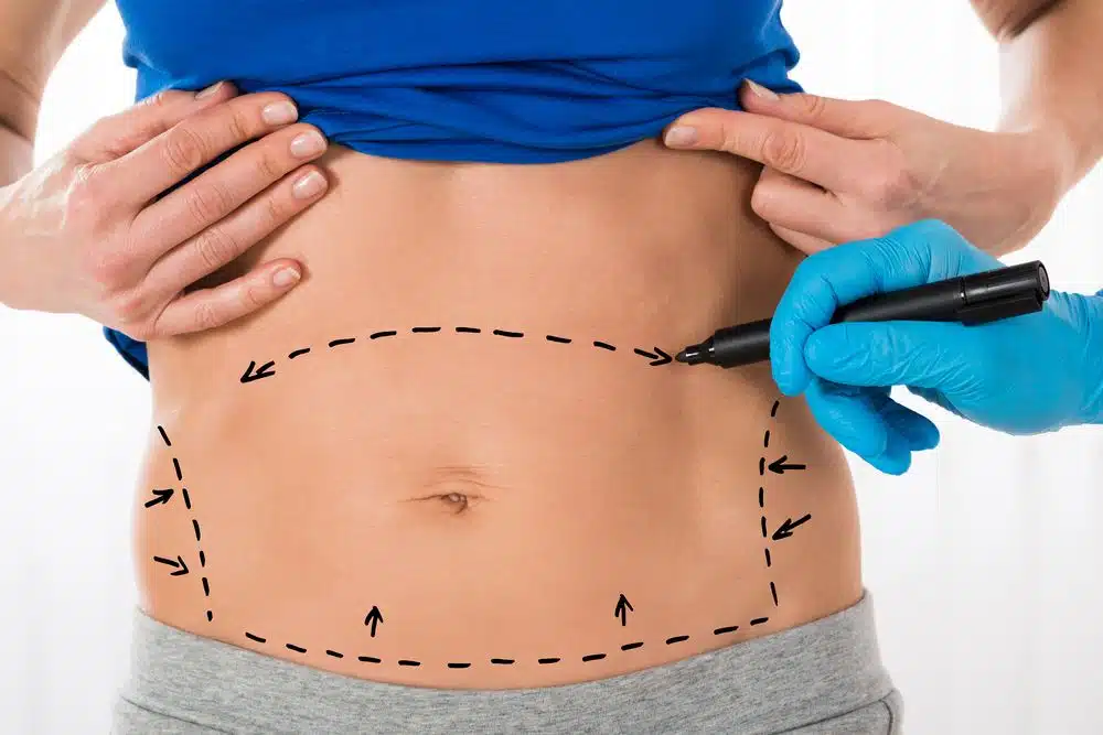 abdominal-liposuction-4