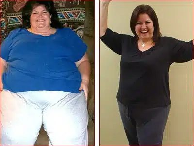 bariatric-surgery-results-debra-2