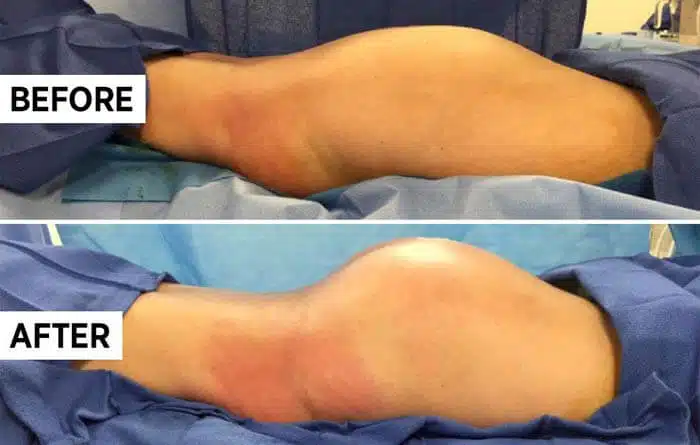 كم هي مدة بقاء نتائج وأثار عملية شد الورك