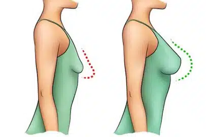 breast-augmentation-2