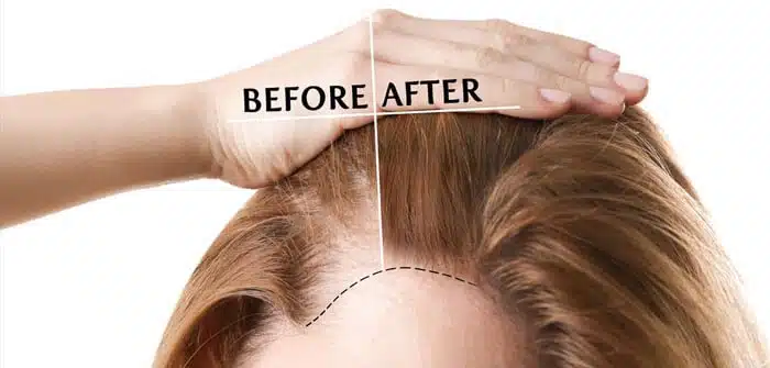 زراعة الشعر في النساء