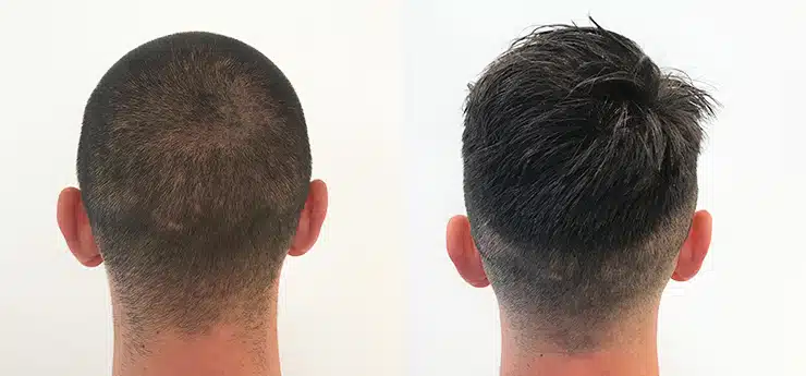 jorge-before-after-his-hair-transplant-donor-area